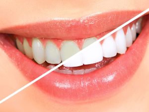 The Dental Centre London – Positive Effects of Teeth Whitening